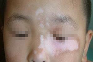 白癜风患者怎样配合对治疗有利