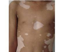 男性手部白癜风应该如何治疗才好