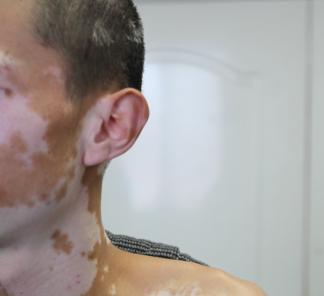 老年白癜风的治疗需要注意些什么